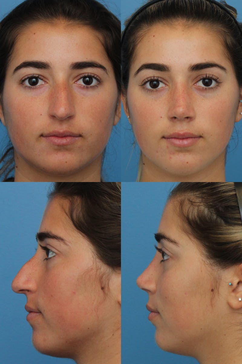 Rhinoplasty