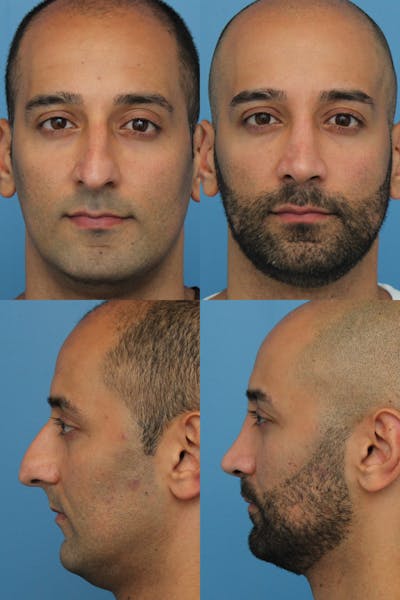 Rhinoplasty Before & After Gallery - Patient 2162053 - Image 1