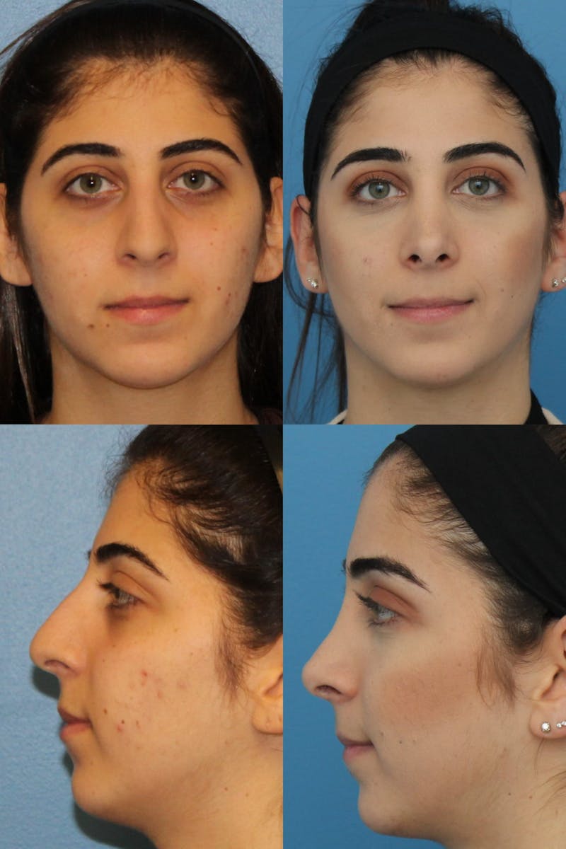 Female Rhinoplasty Before & After Gallery - Patient 2388178 - Image 1