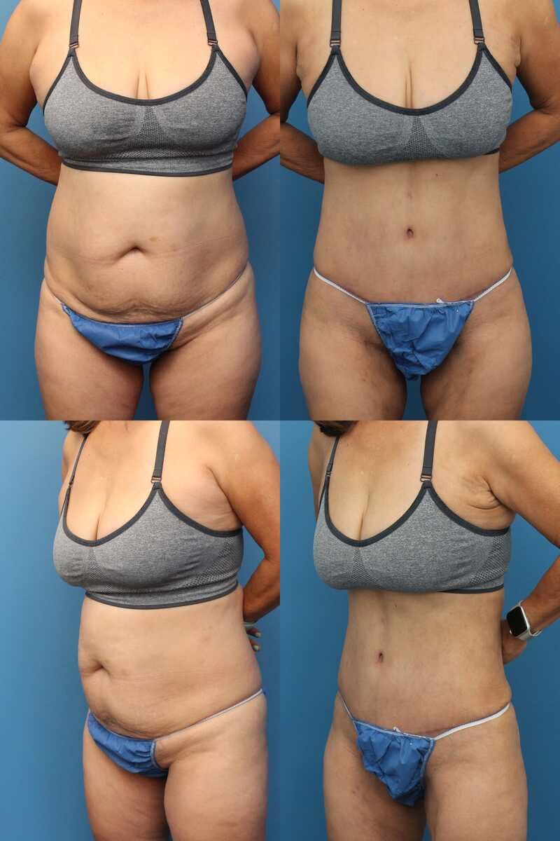 Tummy Tuck Before & After Gallery - Patient 2162062 - Image 1