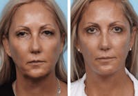 Dr. Balikian's Facelift Before & After Gallery - Patient 2167261 - Image 1