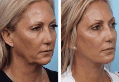 Dr. Balikian's Facelift Before & After Gallery - Patient 2167261 - Image 2