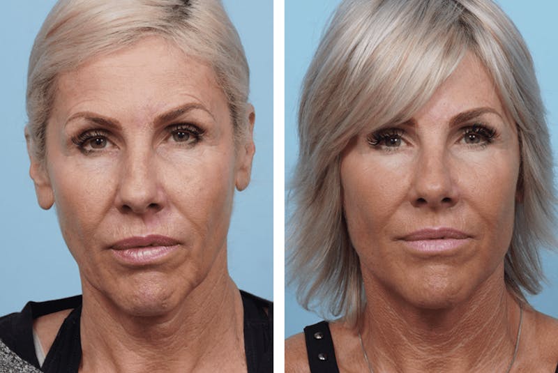 Dr. Balikian's Facelift Before & After Gallery - Patient 2167283 - Image 1