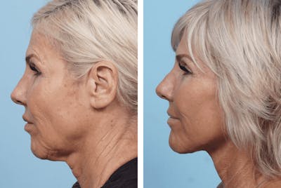Dr. Balikian's Facelift Before & After Gallery - Patient 2167283 - Image 2