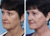 Dr. Balikian's Facelift Gallery - Patient 2167286 - Image 1