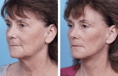 Dr. Balikian's Facelift Before & After Gallery - Patient 2167289 - Image 1