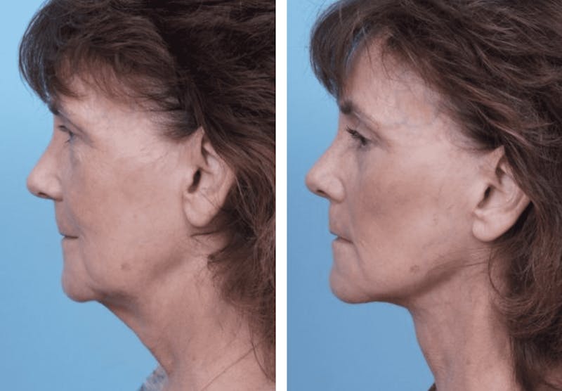 Dr. Balikian's Facelift Before & After Gallery - Patient 2167289 - Image 2