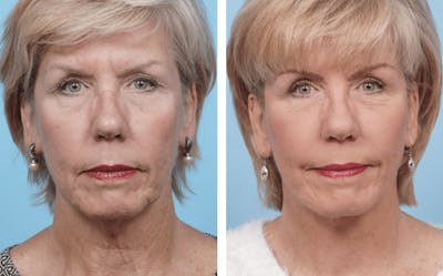 Dr. Balikian's Facelift Before & After Gallery - Patient 2167294 - Image 1