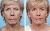 Dr. Balikian's Facelift Before & After Gallery - Patient 2167294 - Image 1