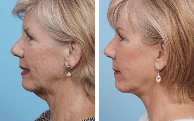 Dr. Balikian's Facelift Before & After Gallery - Patient 2167294 - Image 2