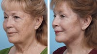 Dr. Balikian's Facelift Before & After Gallery - Patient 2167296 - Image 1