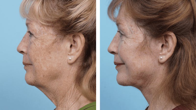 Dr. Balikian's Facelift Before & After Gallery - Patient 2167296 - Image 2