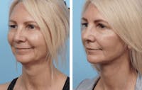Dr. Balikian's Facelift Before & After Gallery - Patient 2167300 - Image 1
