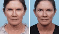 Dr. Balikian's Facelift Before & After Gallery - Patient 2167303 - Image 1
