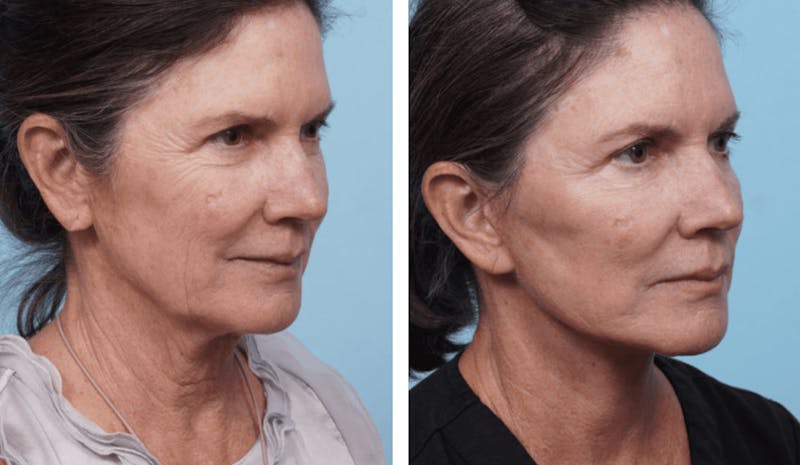 Dr. Balikian's Facelift Before & After Gallery - Patient 2167303 - Image 2
