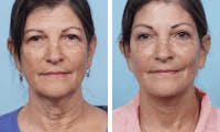 Dr. Balikian's Facelift Before & After Gallery - Patient 2167305 - Image 1