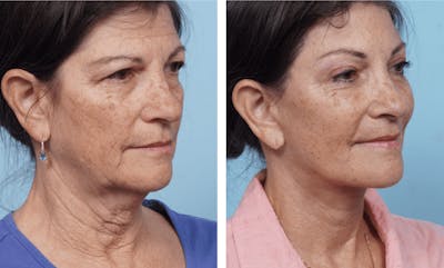 Dr. Balikian's Facelift Before & After Gallery - Patient 2167305 - Image 2