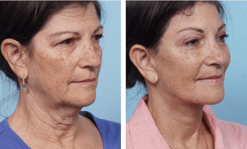 Dr. Balikian's Facelift Before & After Gallery - Patient 2167305 - Image 2
