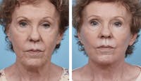 Dr. Balikian's Facelift Before & After Gallery - Patient 2167308 - Image 1