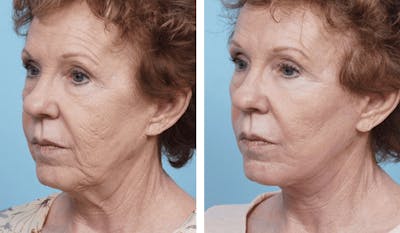 Dr. Balikian's Facelift Before & After Gallery - Patient 2167308 - Image 2