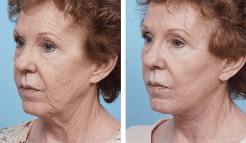 Dr. Balikian's Facelift Before & After Gallery - Patient 2167308 - Image 2