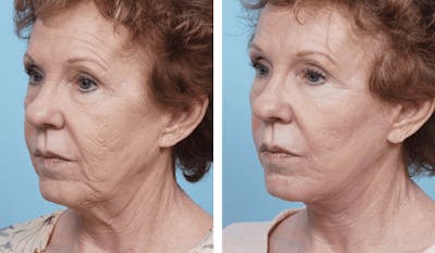 Dr. Balikian's Facelift Gallery - Patient 2167308 - Image 2