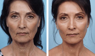 Dr. Balikian's Facelift Before & After Gallery - Patient 2167311 - Image 1
