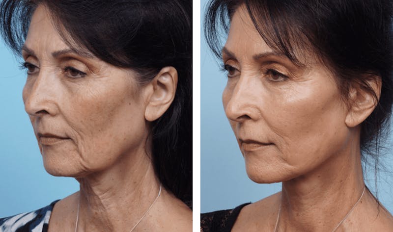 Dr. Balikian's Facelift Before & After Gallery - Patient 2167311 - Image 2