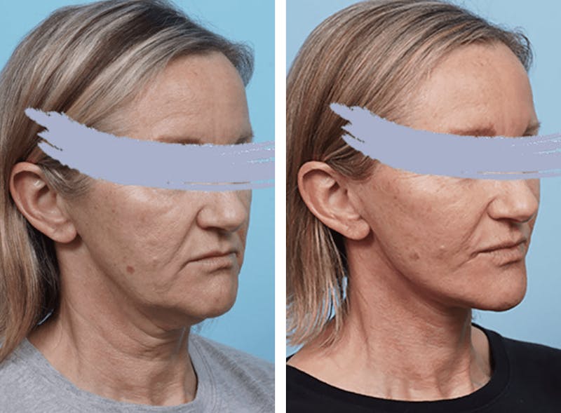 Dr. Balikian's Facelift Gallery - Patient 2167314 - Image 1