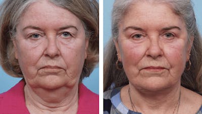 Dr. Balikian's Facelift Before & After Gallery - Patient 2167318 - Image 1