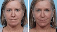 Dr. Balikian's Facelift Before & After Gallery - Patient 2167324 - Image 1