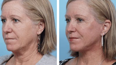 Dr. Balikian's Facelift Before & After Gallery - Patient 2167324 - Image 2