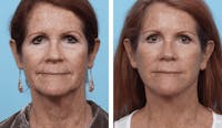 Dr. Balikian's Facelift Before & After Gallery - Patient 2167330 - Image 1