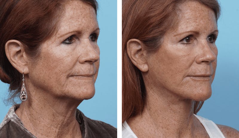 Dr. Balikian's Facelift Gallery - Patient 2167330 - Image 2