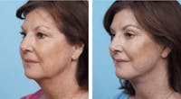 Dr. Balikian's Facelift Before & After Gallery - Patient 2167333 - Image 1