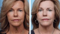 Dr. Balikian's Facelift Before & After Gallery - Patient 2167335 - Image 1