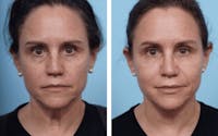 Dr. Balikian's Facelift Before & After Gallery - Patient 2167338 - Image 1