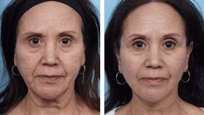 Dr. Balikian's Facelift Before & After Gallery - Patient 2167342 - Image 1