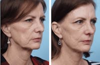 Dr. Balikian's Facelift Before & After Gallery - Patient 2167350 - Image 1