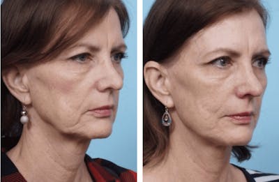 Dr. Balikian's Facelift Before & After Gallery - Patient 2167350 - Image 1