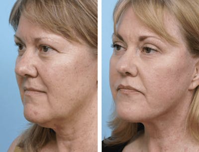 Dr. Balikian's Facelift Before & After Gallery - Patient 2167353 - Image 1