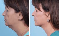 Dr. Balikian's Facelift Before & After Gallery - Patient 2167357 - Image 1
