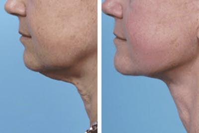 Dr. Balikian's Facelift Before & After Gallery - Patient 2167360 - Image 1