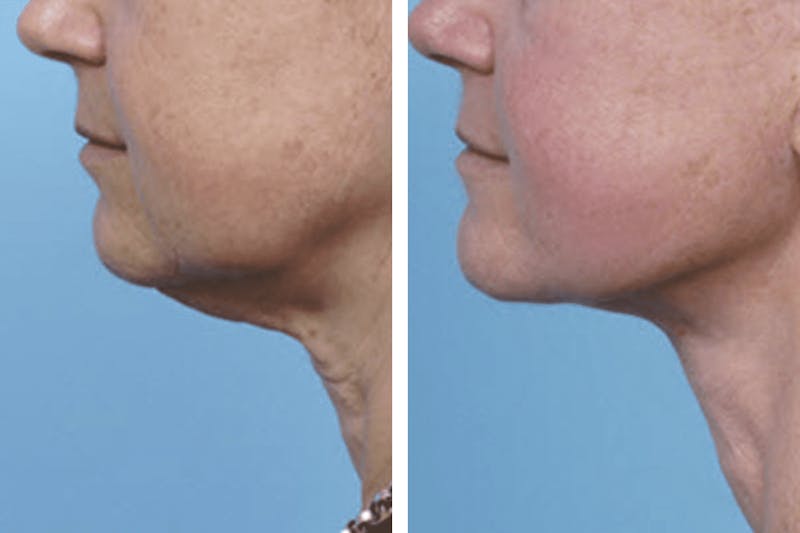 Dr. Balikian's Facelift Gallery - Patient 2167360 - Image 1