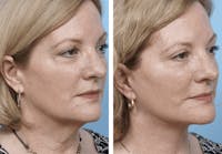 Dr. Balikian's Facelift Before & After Gallery - Patient 2167367 - Image 1