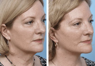 Dr. Balikian's Facelift Before & After Gallery - Patient 2167367 - Image 1