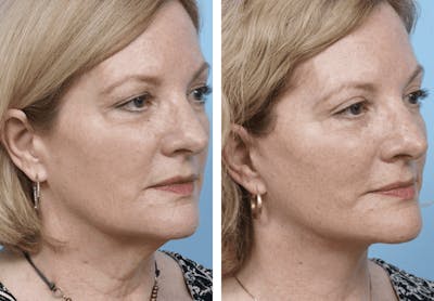 Dr. Balikian's Facelift Gallery - Patient 2167367 - Image 1