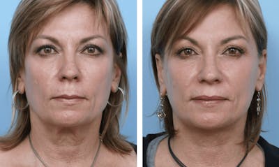 Dr. Balikian's Facelift Before & After Gallery - Patient 2167369 - Image 1