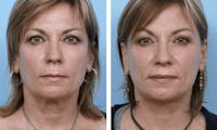 Dr. Balikian's Facelift Before & After Gallery - Patient 2167369 - Image 1