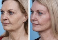 Dr. Balikian's Facelift Before & After Gallery - Patient 2167371 - Image 1